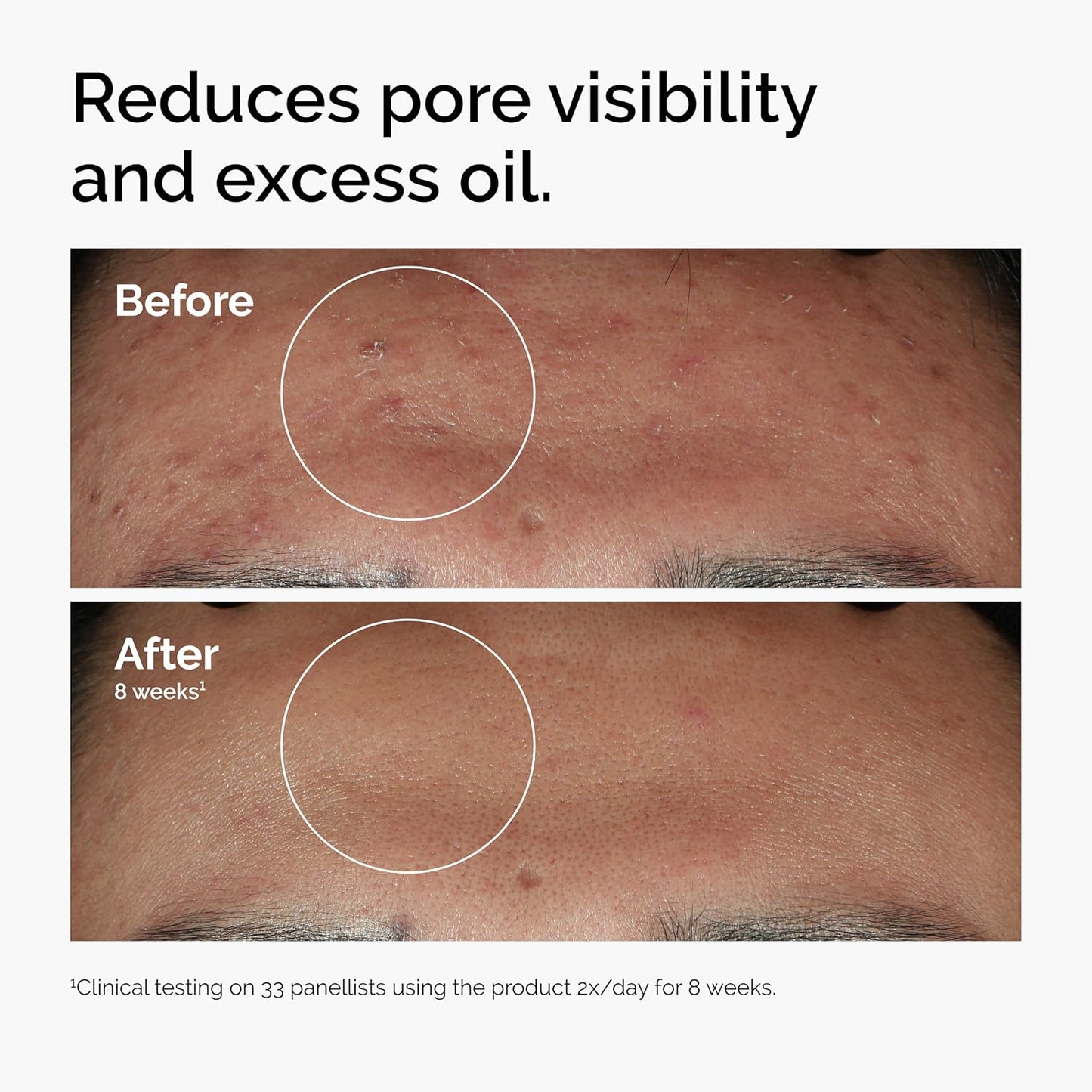 The Ordinary Niacinamide 10% + Zinc 1% - Smoothing Serum for Blemish-Prone Skin